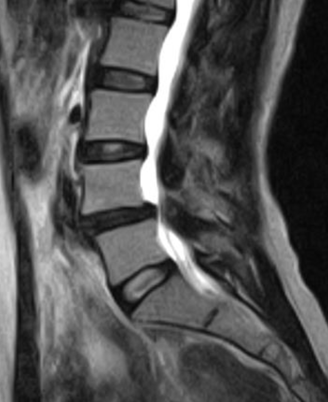 Patients spine before Dr Hotts surgery.