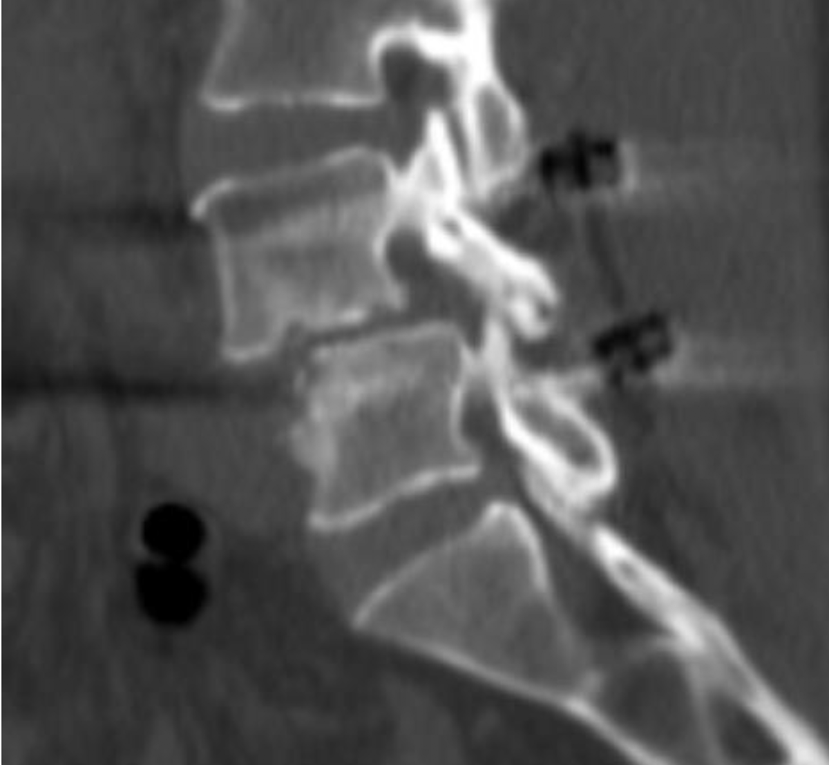 Patients spine before Dr Hotts surgery.