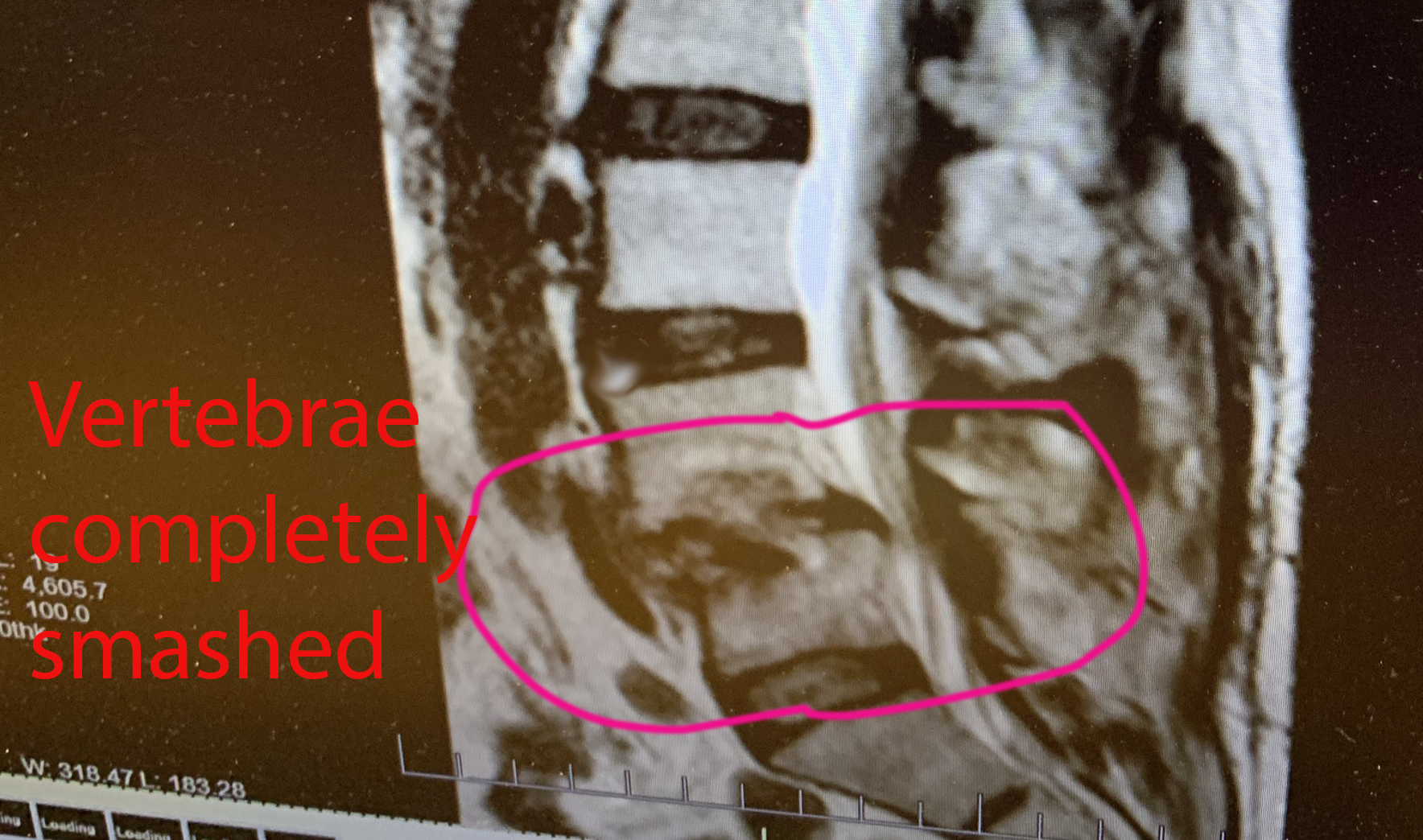 Patients spine before Dr Hotts surgery.